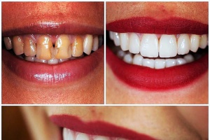 Основные этапы протезирования зубов