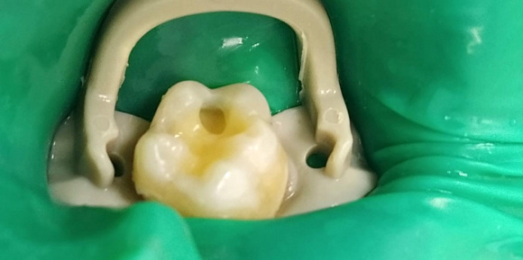 Лечение зуба у ребенка (реставрация)