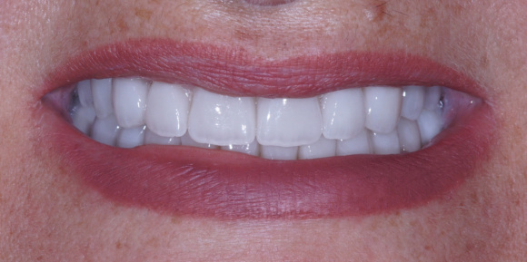 Цвет яркий Bleach3, протезирование зубов
