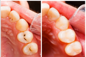 Зубы и чем они болеют