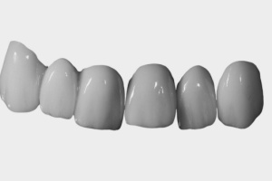 Протезирование безметалловой керамикой