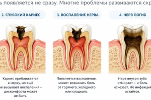Почему зуб не болит, хотя проблема уже серьезная?