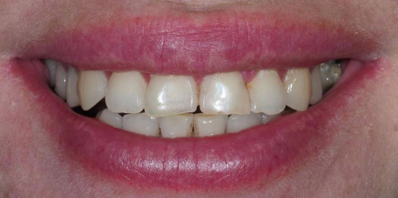 Имплантация зубов (4 имплантата)