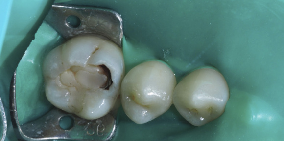 Реставрация, лечение кариеса зубов до и после