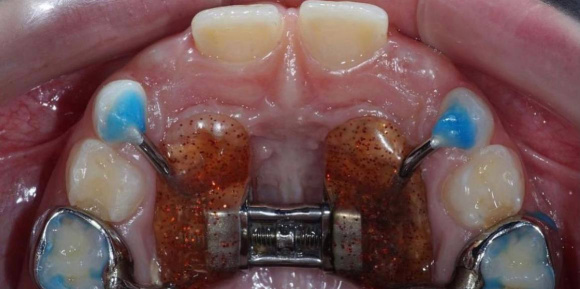Расширение верхней челюсти (молочные зубы)