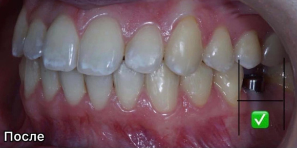 Выравнивание зубов, подготовка к протезированию