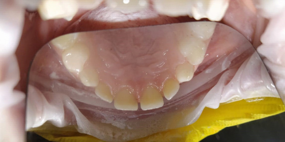 Чистка зубов (детская стоматология)