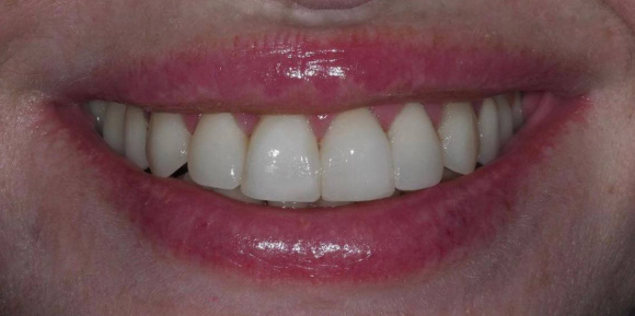 Имплантация зубов (4 имплантата)
