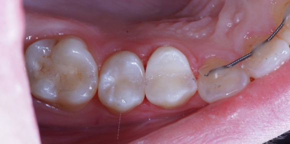 Реставрация жевательных зубов