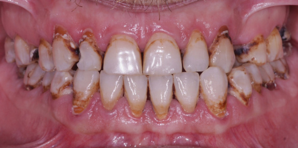 Лечение кариеса зубов с предварительной чисткой