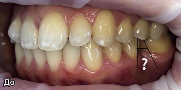 Выравнивание зубов, подготовка к протезированию