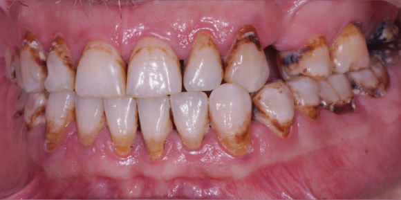 Профессиональная чистка и лечение зубов