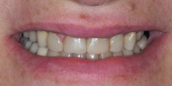 Цвет яркий Bleach3, протезирование зубов