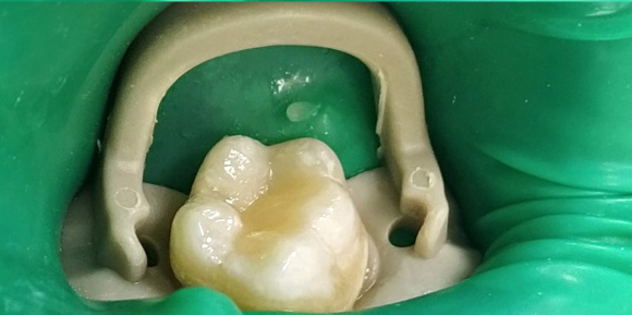 Лечение зуба у ребенка (реставрация)